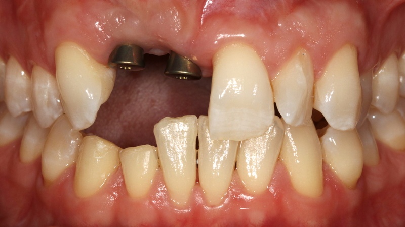 Dental Implants in San Francisco, CA