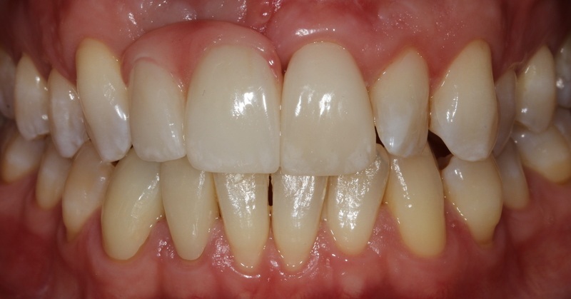 Our Prosthodontist Placed dental crowns over the dental implants in San Francisco, CA